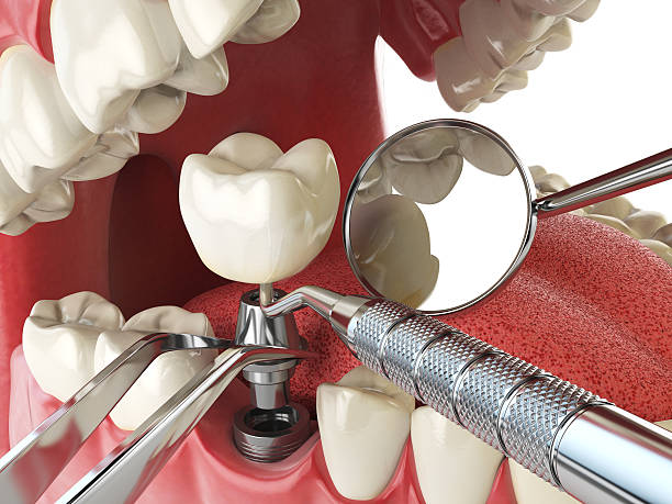 Best Emergency Root Canal Treatment in Lexington, NE